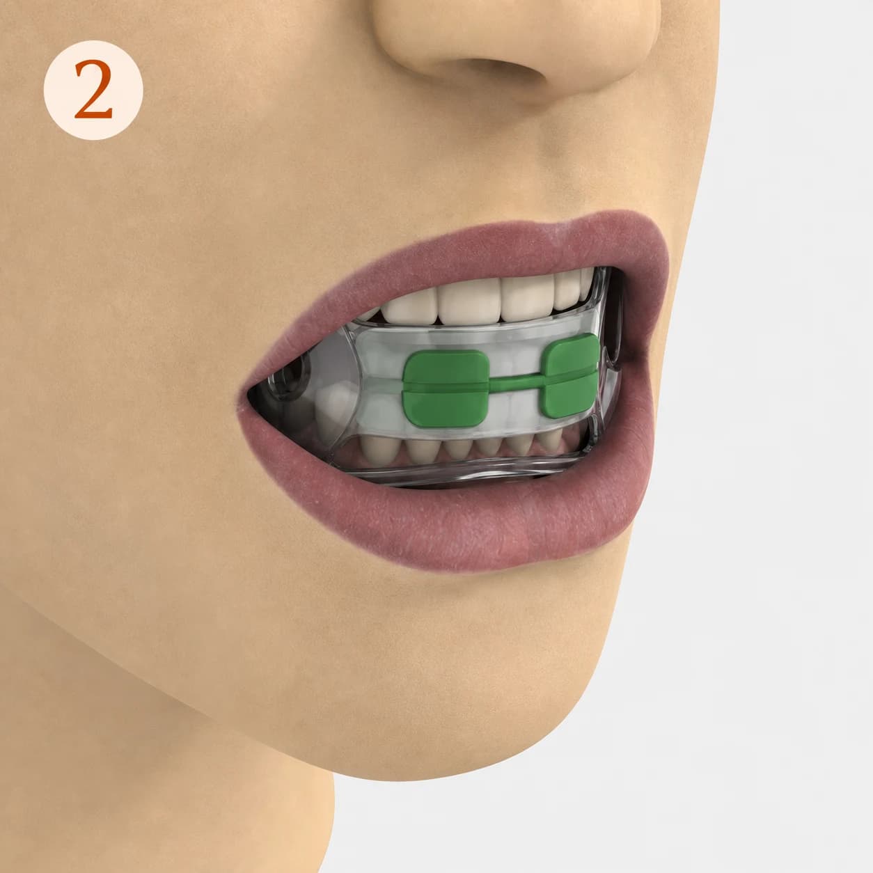 Krok 2: umieszczenie stymulatora odciążającego w jamie ustnej